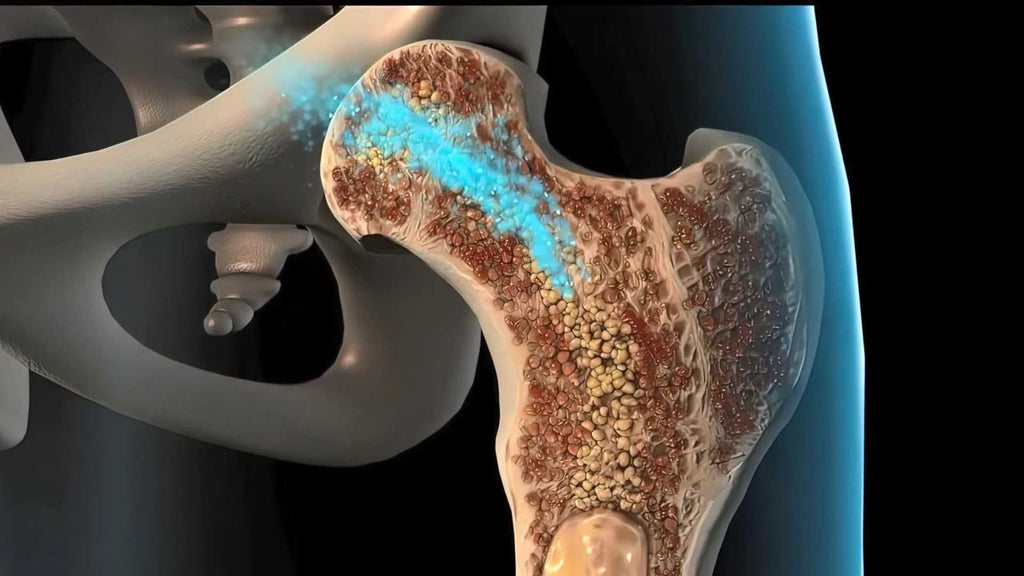 Osteoporosis in the hip