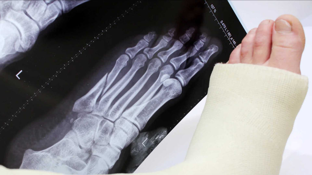 Broken Foot in a cast