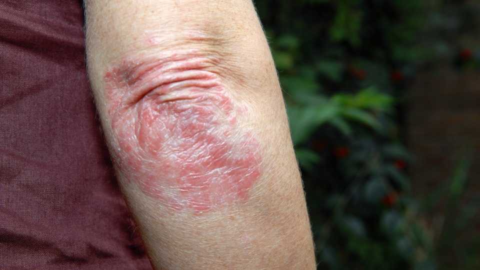 Psoriasis can cause itchy skin