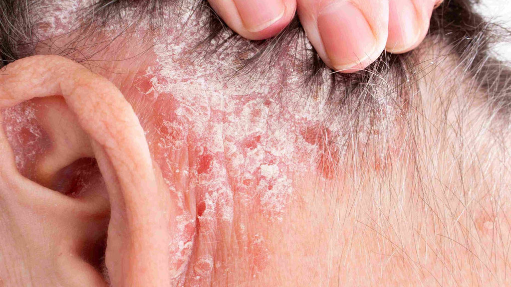 Psoriasis behind the ear