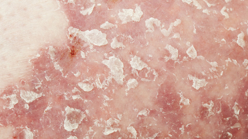 La psoriasis es una acumulación de células de la piel en parches escamosos