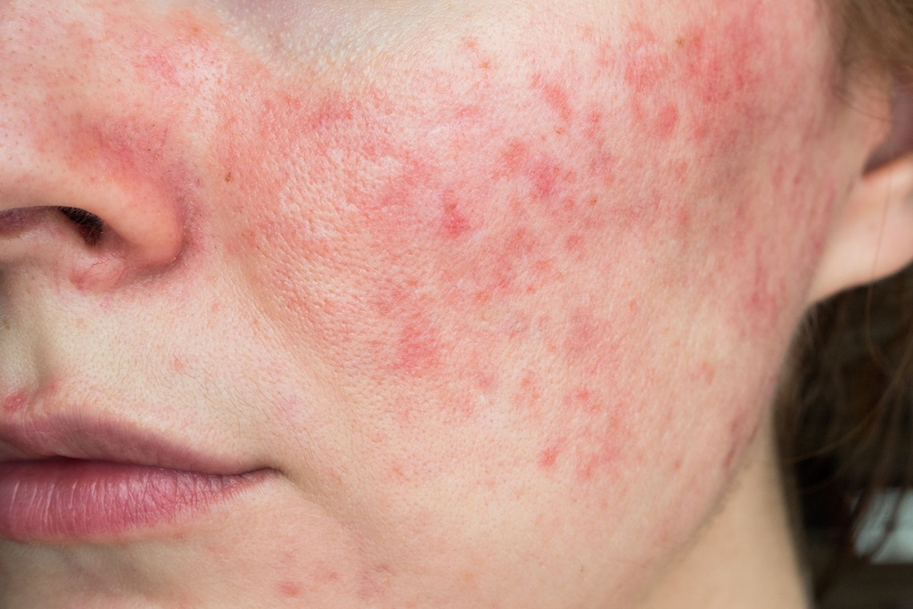 Rosacea face