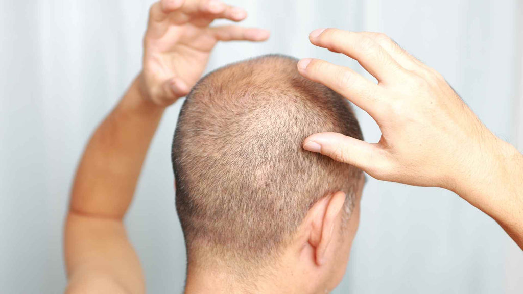 A man with a sunburned scalp