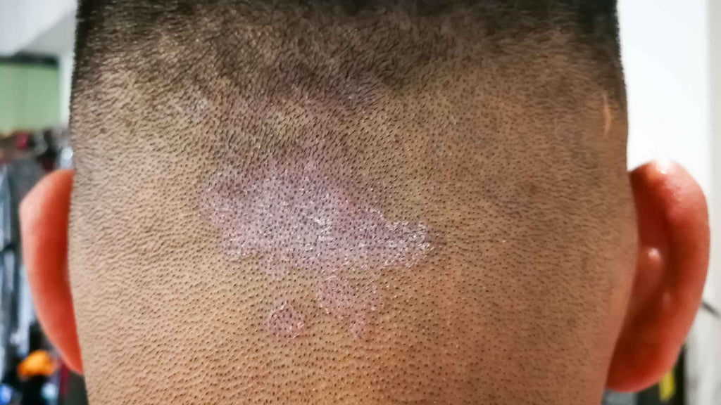 Patient with ringworm on his scalp