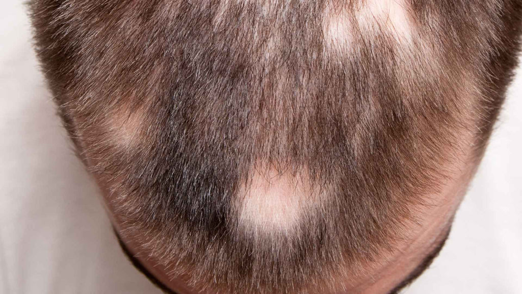 Patchy bald spots on head