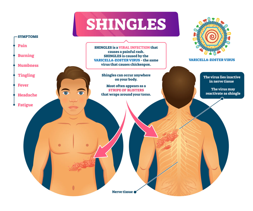 Shingles Infographic