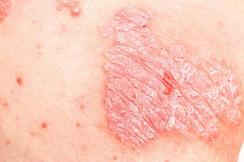 Skin irritation from topical steroid withdrawal
