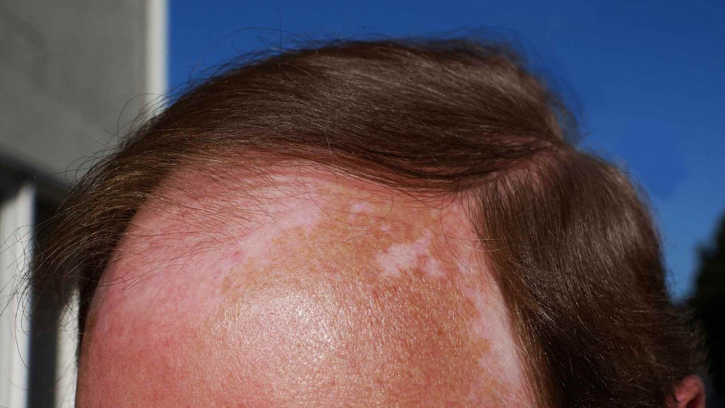 Image of a sunburned scalp