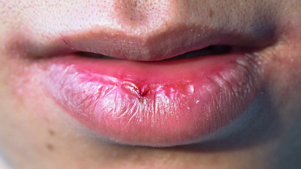 Symptom's of Lip Licker's Dermatitis