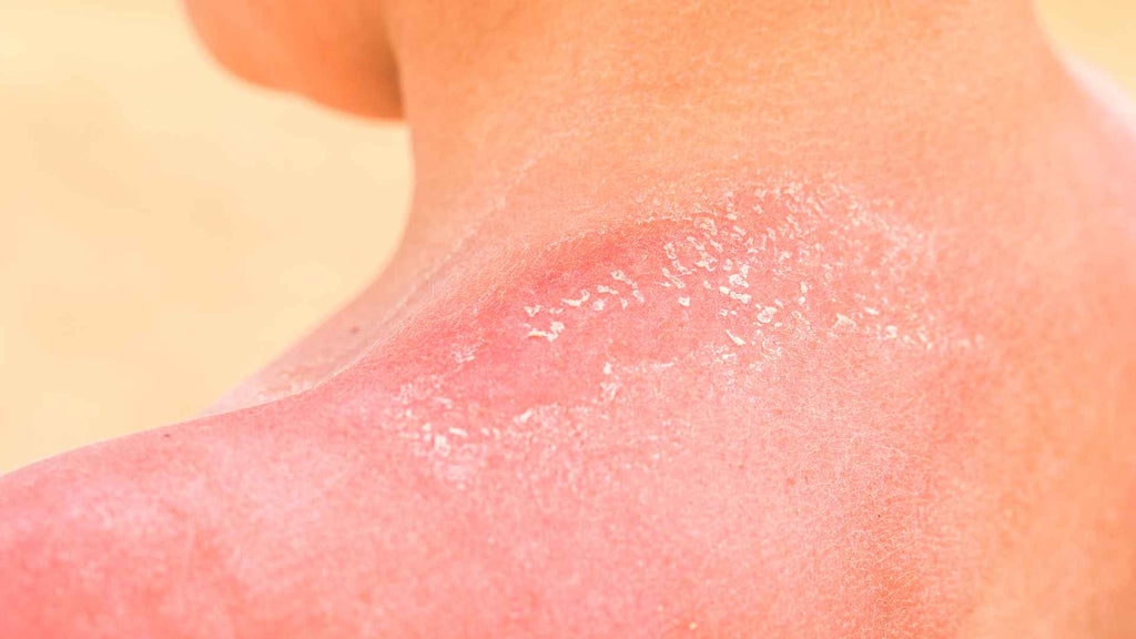 Inflammation and redness from TSW