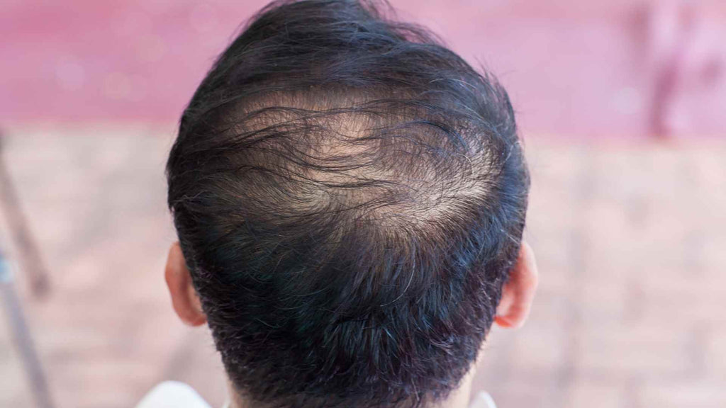 A man with thinning hair