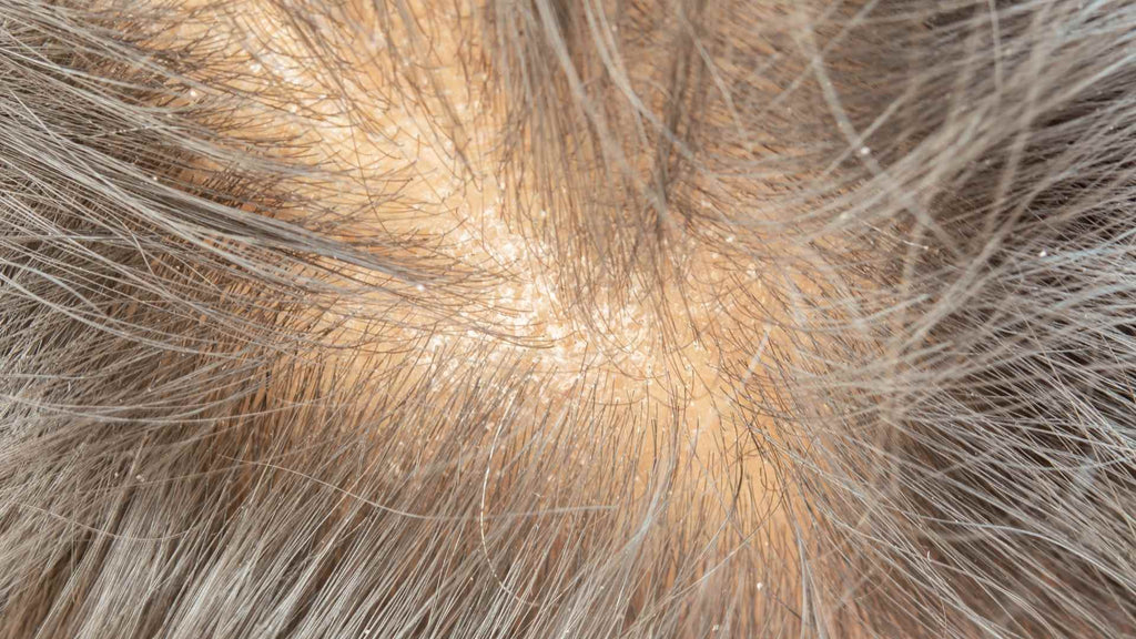 A scalp with thinning hair is at risk for sunburn
