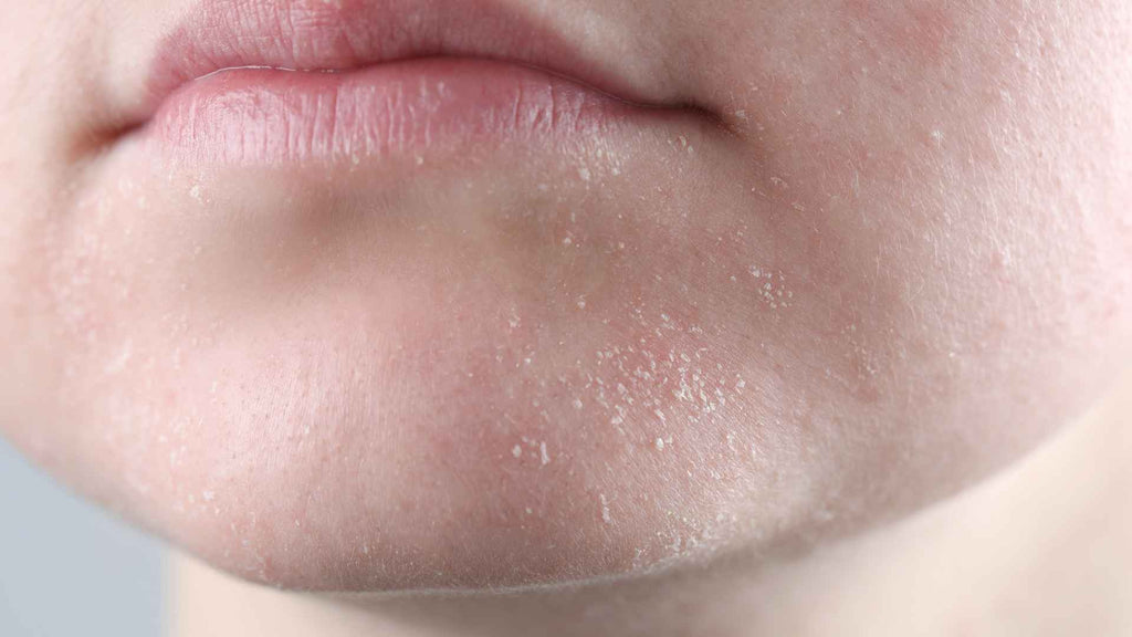 Close-up of a person's mouth area showing dry, chapped lips with visible flaky skin.