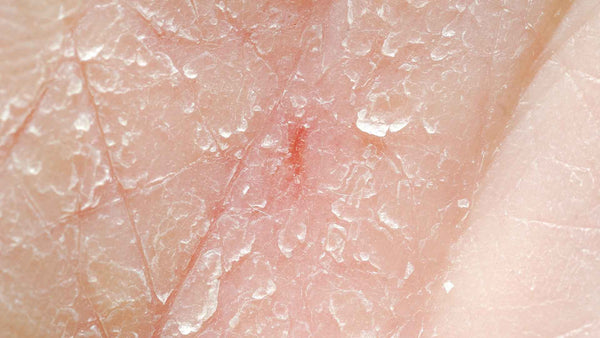 Dry skin can contribute to anal itching