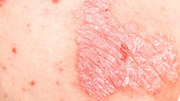 Psoriasis can contribute to anal itching