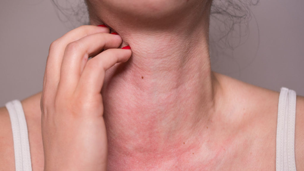 Una mujer con una reacción alérgica le toca el cuello con la mano.