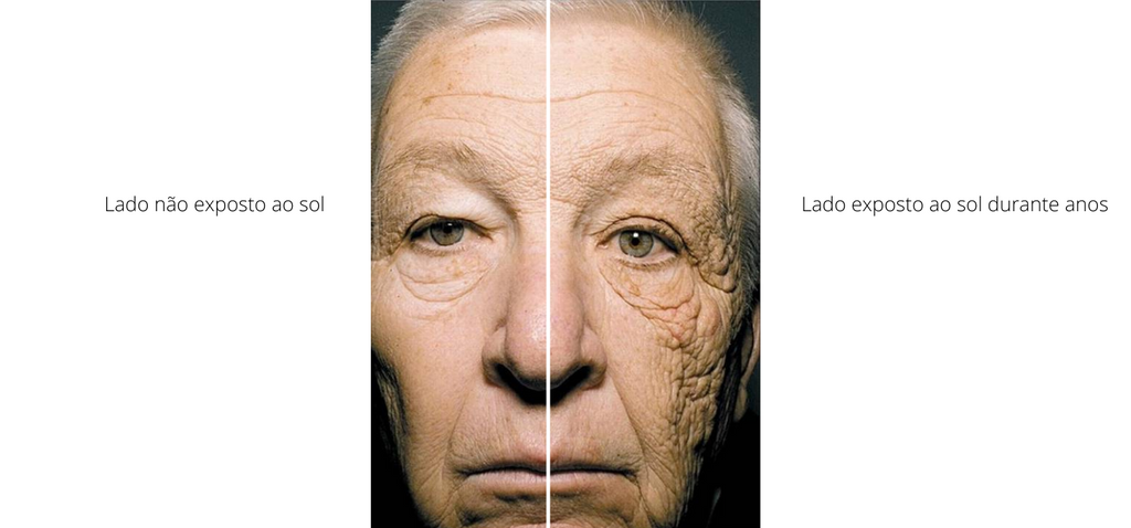 Wrinkles with Sun Exposure