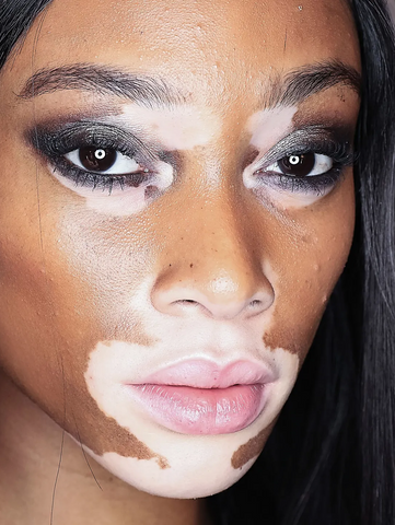 vitiligo phototherapy