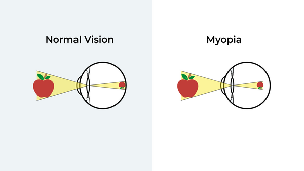 myopia