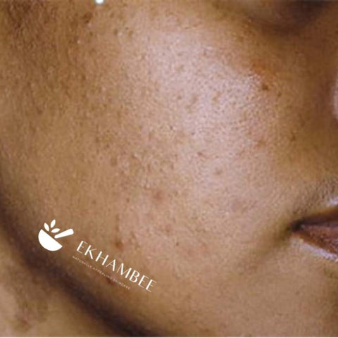Black woman skin with clogged pores and bumps with Ekhambee logo
