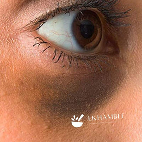dark eye circle under woman with brown skin eye