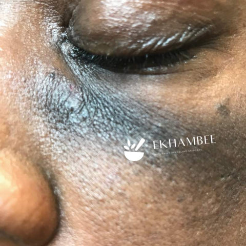 hyperpigmentation dark spot on black woman face