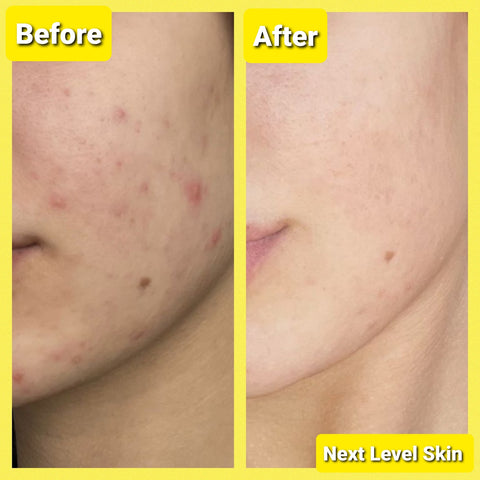 A woman before and after results from using Next Level Skin charcoal clay masks.