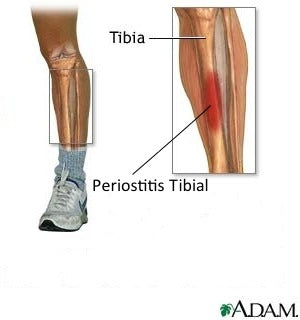 medial tibial stress syndrome visual