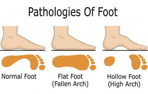 flat foot pathologies