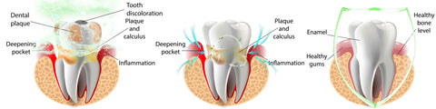 Sèrum dental d'un sol ús blanquejador antiinflamatori Smile