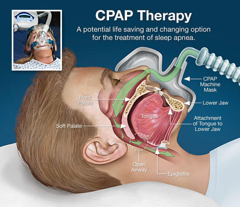 CPAP therapy