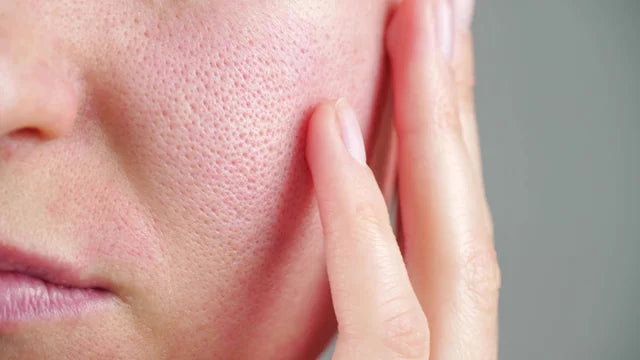 How to get rid of open pores Easily and Naturally