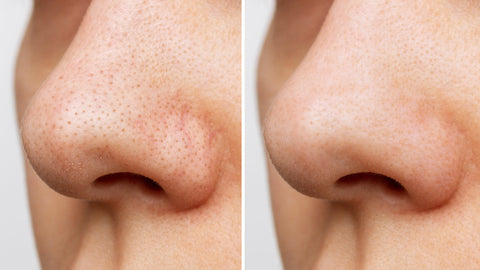 Blackheads before and after