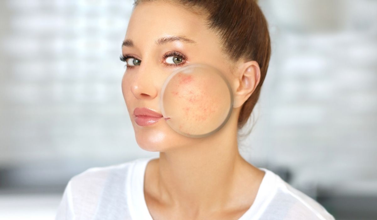 Woman with the acne scars