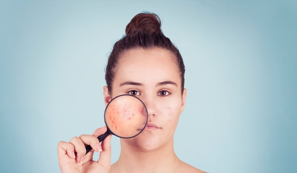 Young woman with acne