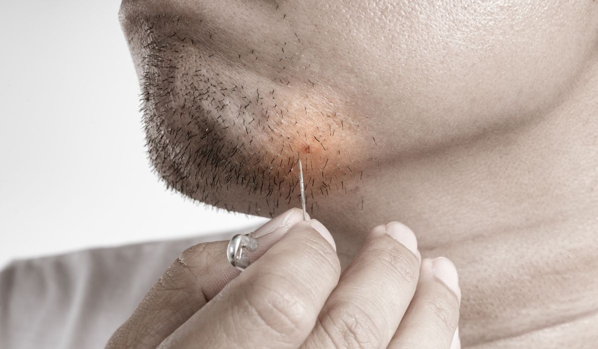 Man is trying to remove the ingrown facial hair