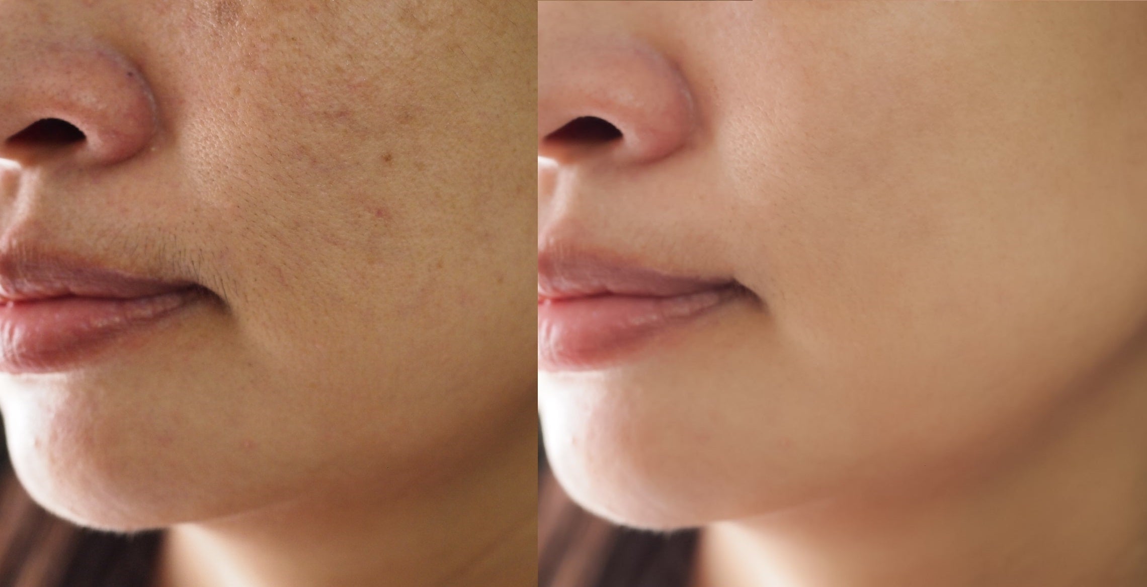 IPL treatment for pigmentation before and after 