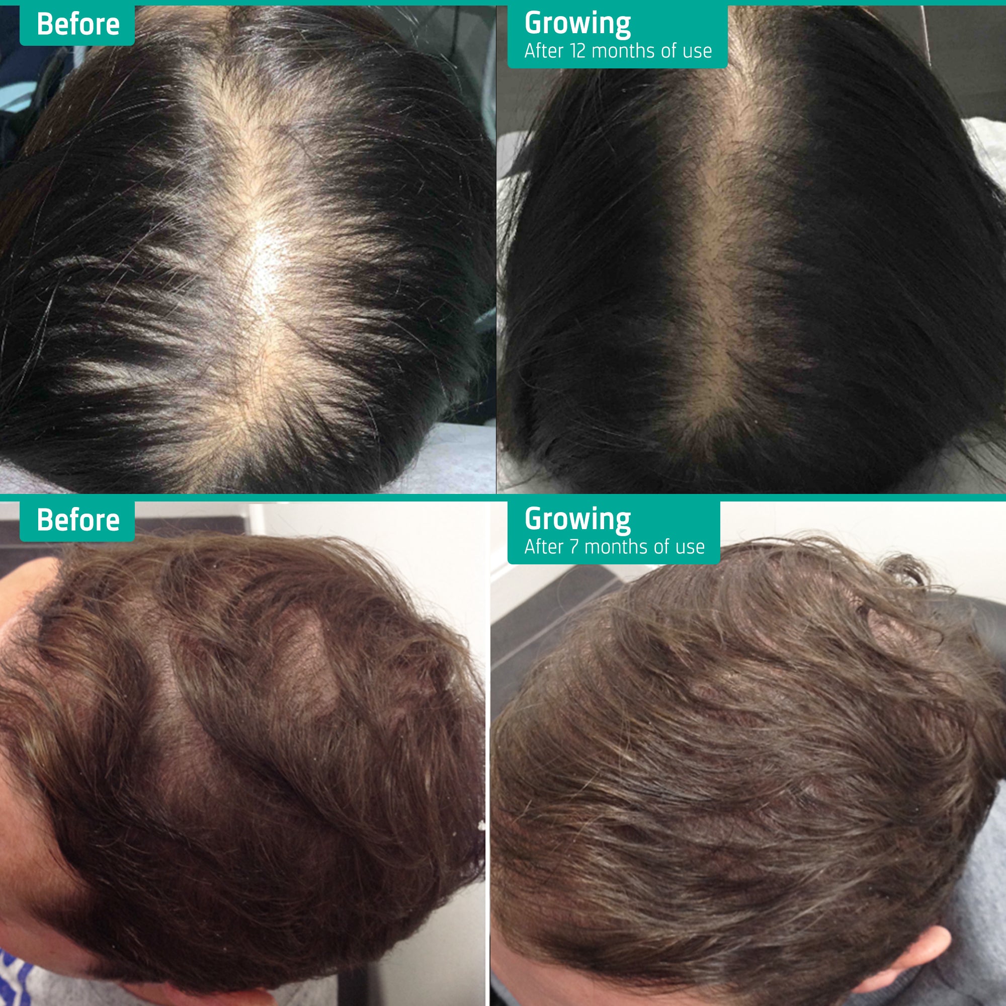 Treatment for Thinning Hair - Neofollics Hong Kong
