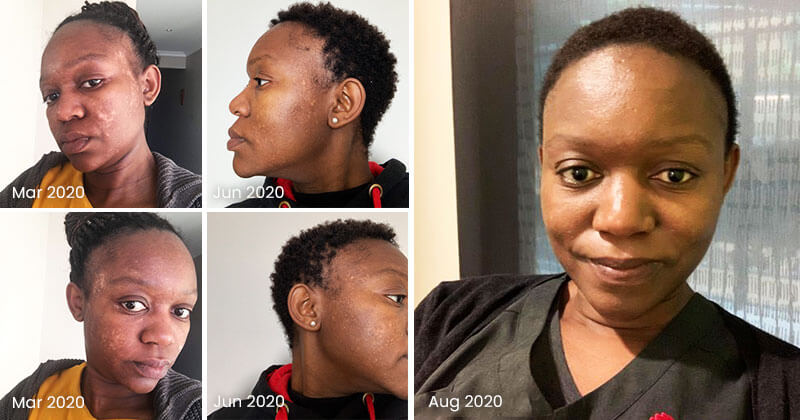 A-Sivindani Vitiligo Organics Real Results Before After