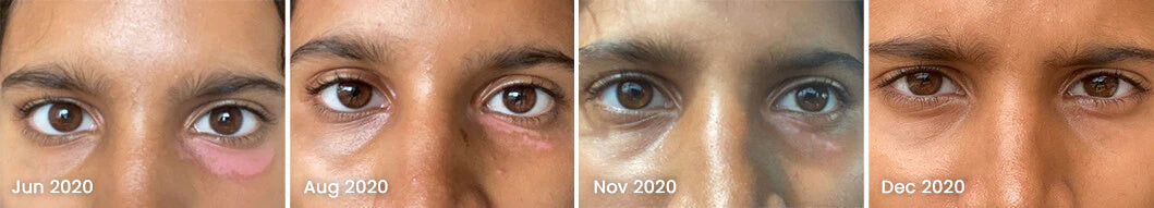 Vitiligo Organics Real Results Before After