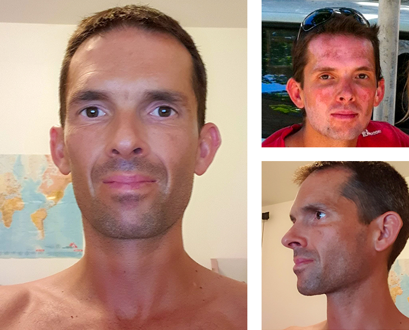 before-after-vo-loic