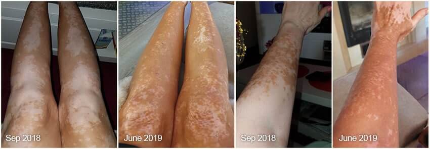 Vitiligo Real Results Before After