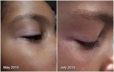 Vitiligo Real Results Before After