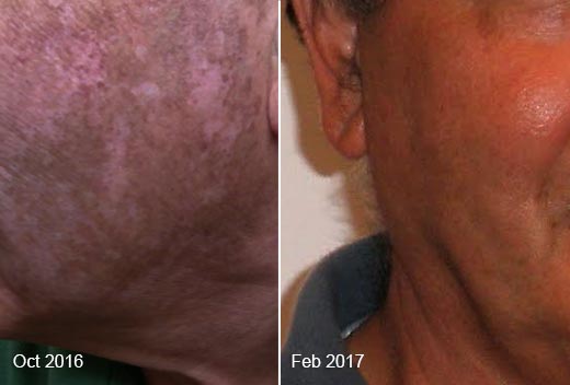 Vitiligo Real Results Before After