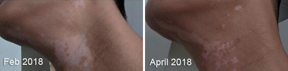 Vitiligo Real Results Before After