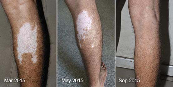 Vitiligo Real Results Before After