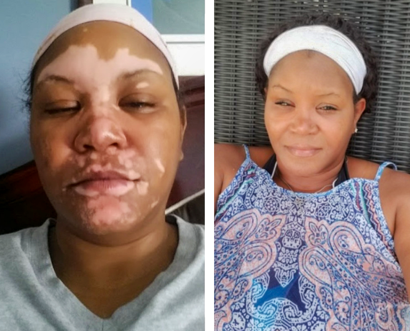 W Moore - Vitiligo Real Results Before After