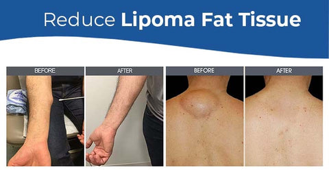 MEDix™ Lipoma Removal Cream