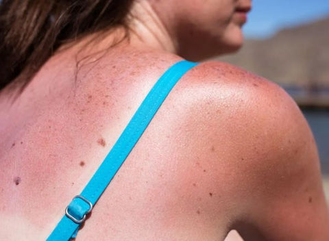you can get sunburn even when you are in a tent or the shade