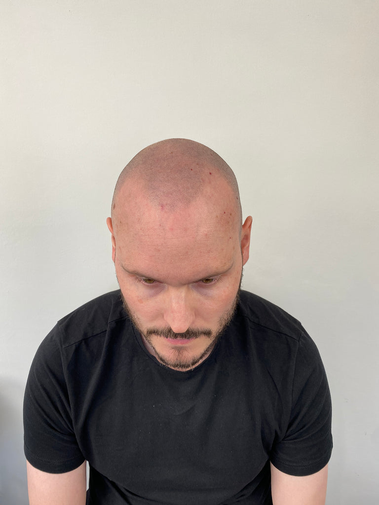 Male pattern baldness Norwood 6. Also, Mitch Pileggi | Mitch pileggi,  American actors, Male pattern baldness